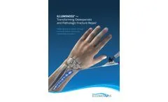 IlluminOss - Transforming Osteoporotic and Pathologic Fracture Repair Brochure