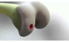 BioPoly RS Knee System Animation - Video