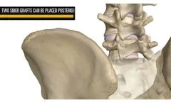 CoreLink SIber Posterior SI Allograft System - Video