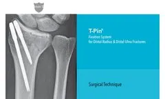 T-Pin - Fixation System for Distal Radius & Distal Ulna Fracture Fixation Brochure