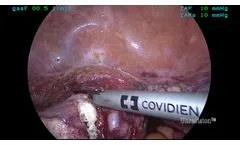 Laparoscopic Hysterectomy Using Ultravision - Video