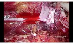 Laparoscopic Retroperitoneal Nephrectomy Using Ultravision - Video