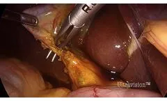 Laparoscopic Cholecystectomy using Ultravision - Video