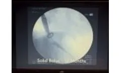 Cure Ex Nail Fungus Laser Device - Video