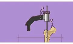 GAP Nail by Pega Medical - Video