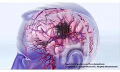 Atrial Fibrillation and Stroke-Microlife - Video