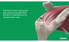 Inion FixOn Biocomposite Suture Anchor - Rotator Cuff Repair - Video