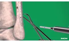 Inion Freedom System - Ankle Fracture Repair - Video