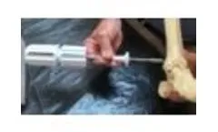 COREX - Distal Tibia - Video