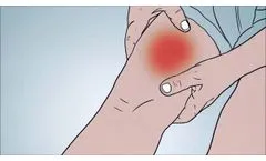 The Truth About Adverse Events - Video