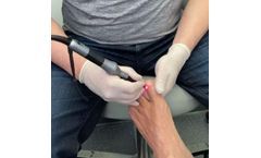 Medical Lasers Systems for Podiatry Lasers