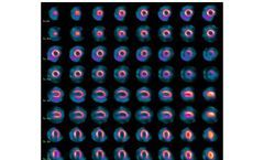 D-SPECT for Clinical Care - Myocardial Perfusion