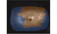 Therapy Solutions for Proliferative Diabetic Retinopathy