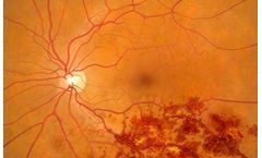 Retinal Vein Occlusion (RVO)
