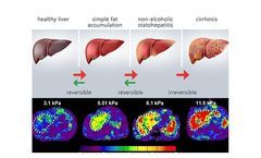 MRE Solution for Liver Disease