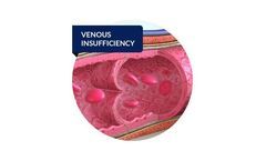 Medical solutions for vascular area