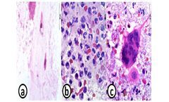Medical diagnostics solutions for inflammatory bowel disease sector