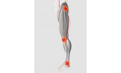 Neuromuscular Electrostimulation Device for Post-Operative Oedema Prevention - Hospital Applications