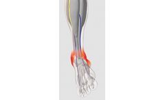 Neuromuscular Electrostimulation Device for Pre-operative Oedema Reduction - Ankle Fracture - Hospital Applications