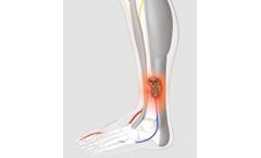 Wound Therapy Applications Device for Mixed Aetiology Leg Ulcers
