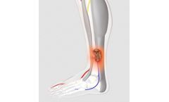 Wound Therapy Applications Device for Venous Leg Ulcers